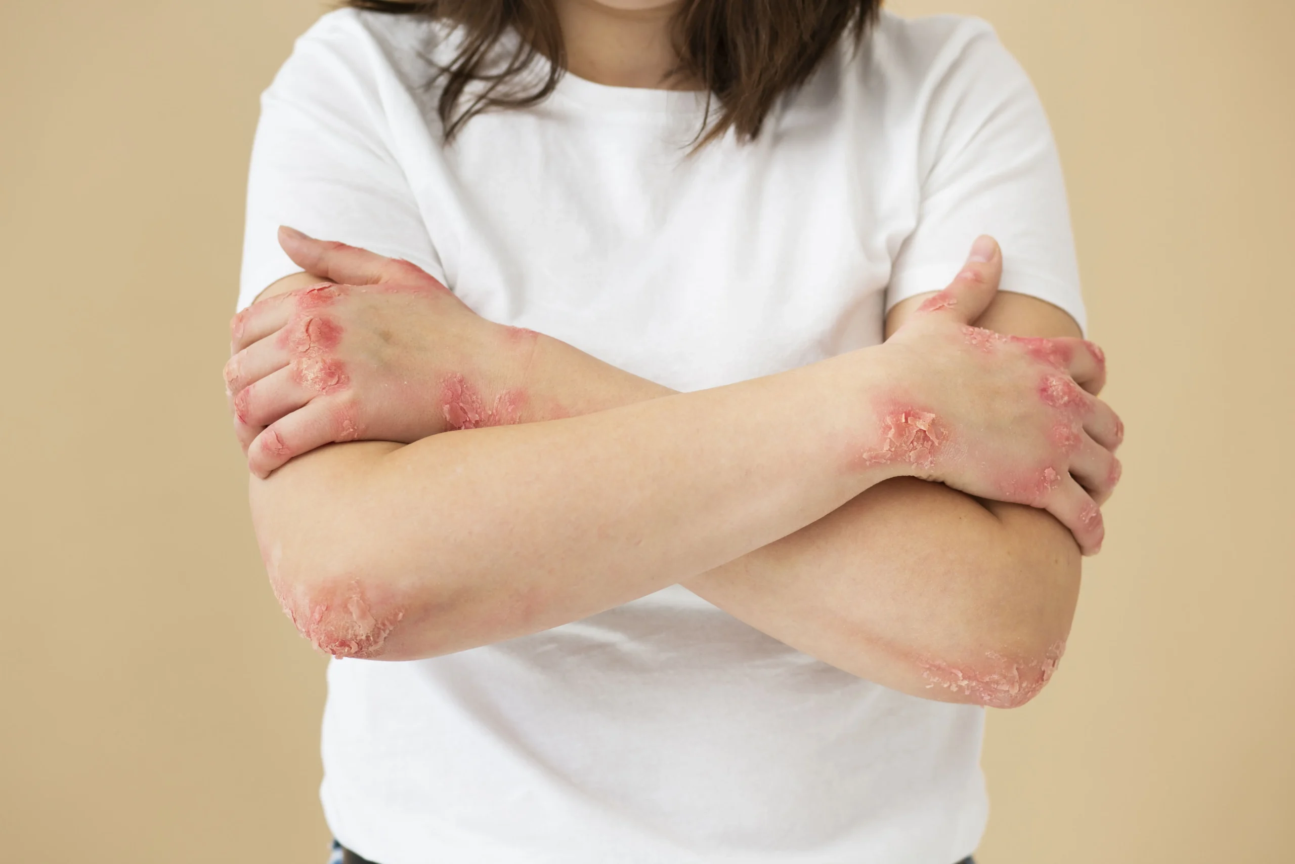 homeopathy for eczema