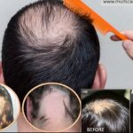 एलोपेशिया एरियाटा (Alopecia Areata) के लिए सर्वोत्तम होम्योपैथिक उपचार – Dr. Brij Homeopathy Clinic, Patna